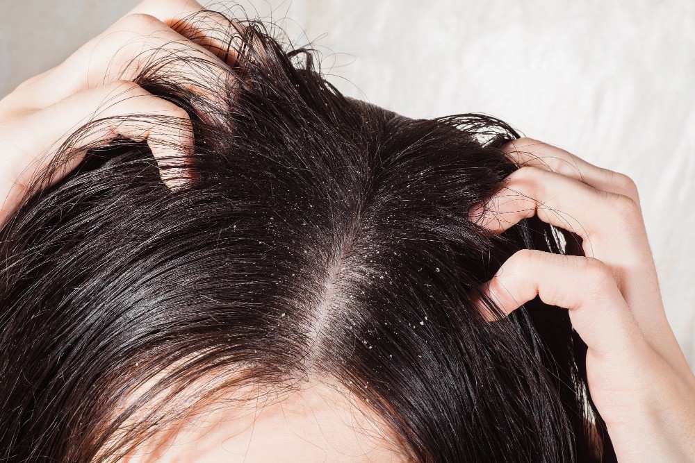 Seborrhoeic Dermatitis / Chronic Dandruff